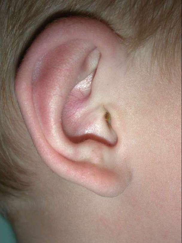 Ear surgery for children
