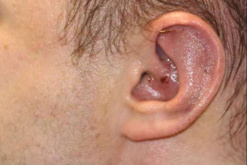 Big ear correction