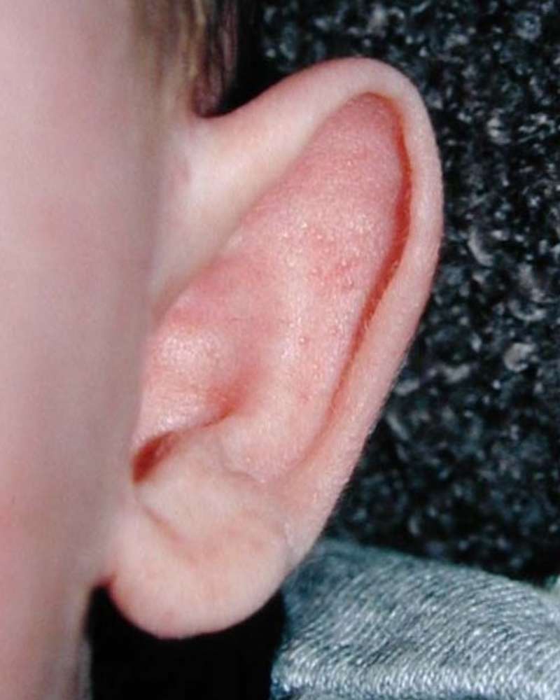 Stick-out ear in a baby