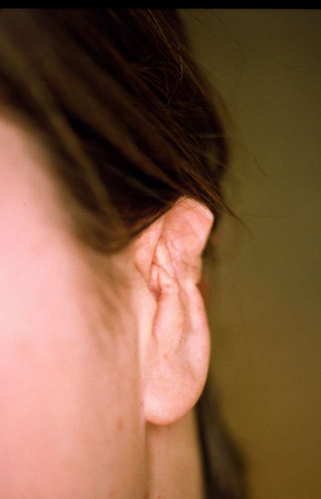Pinnaplasty gone wrong - severe ear deformity 