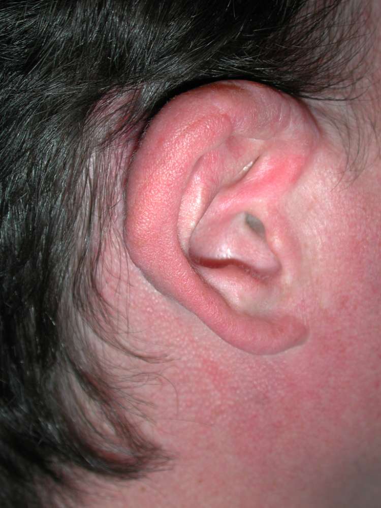 Ear pinning gone wrong 