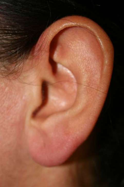 Large ear lobe before surgery 