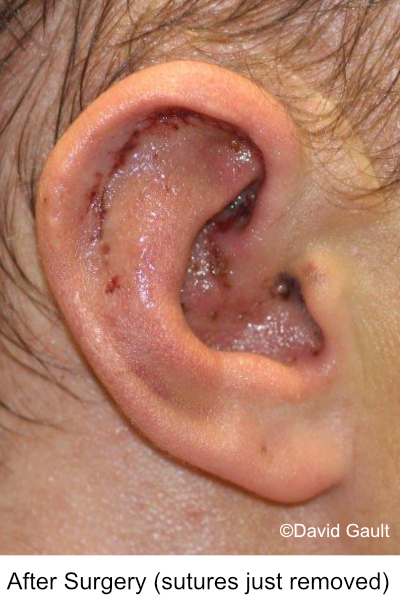David-Gault-Macrotia-Surgery-Results-Right_Ear-5.jpg