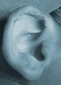 Lop ear surgery showing stitch line