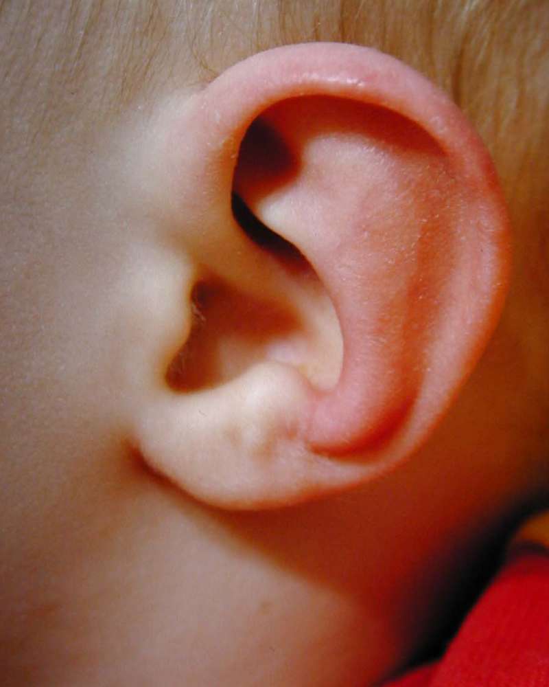 Stahl's ear after EarBuddies 