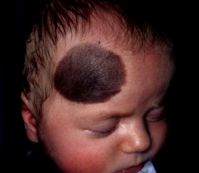 Large brown birthmark 