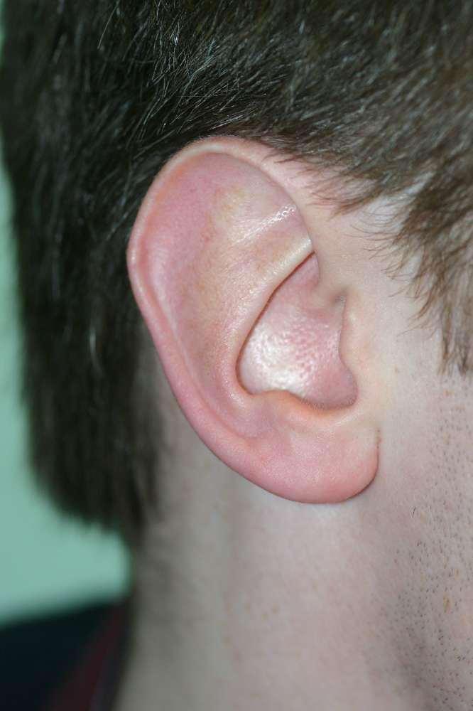 Big ear before surgery.jpg 