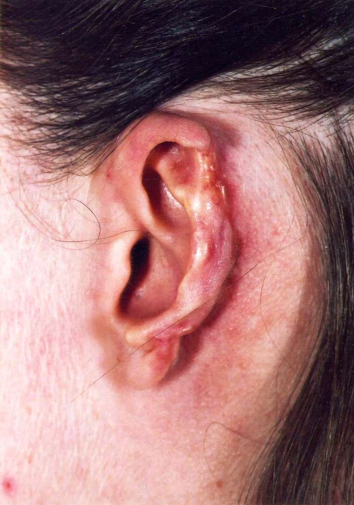 Ear pin back surgery gone wrong - loss of ear rim 
