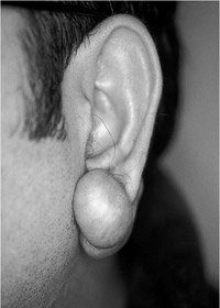 Ear Lobe keloid 