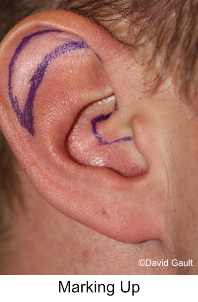 David-Gault-Macrotia-Surgery-Results-Right_Ear-5-Surgical_Marker.jpg 
